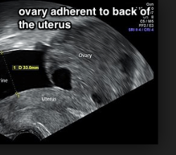 Endometriosis Ovaries