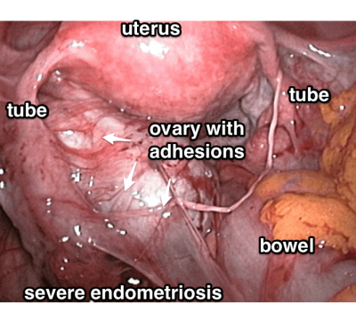 Diagnosing Endometriosis