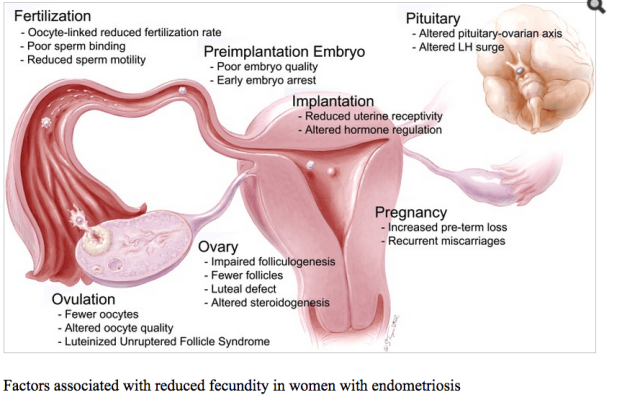 Endometriosis Infertility
